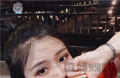 杭州艺星杨连华眼部手术案例价格分享,这个眼睛真的是可爱萌占完了!