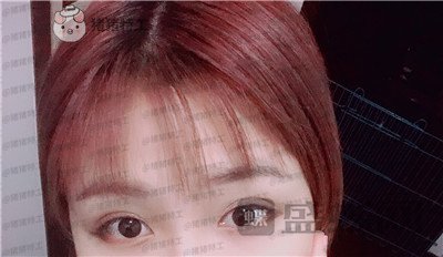 杭州艺星杨连华眼部手术案例价格分享,这个眼睛真的是可爱萌占完了!