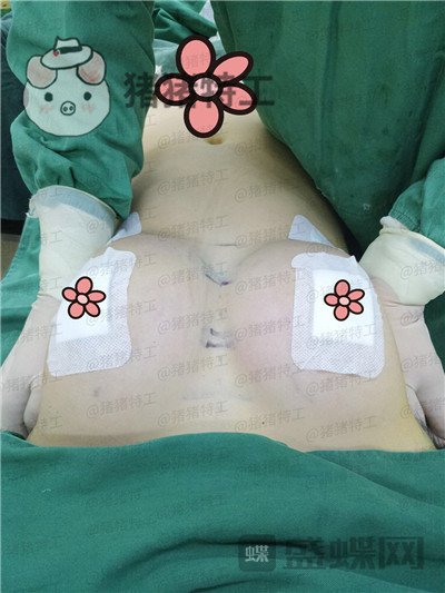 南京美贝尔黄名斗隆胸案例价格分享,穿上伴娘服的我被自己美到了!