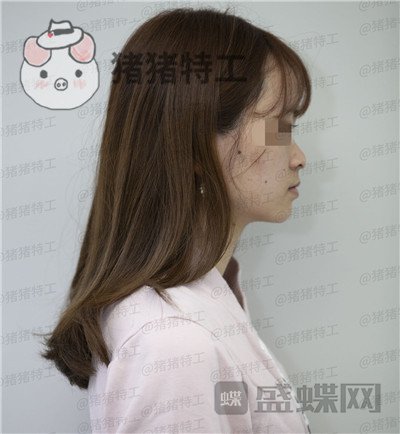 重庆铂生杜亚旭隆鼻案例价格分享,苦尽甘来的感觉一点都不夸张~