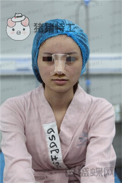重庆铂生杜亚旭隆鼻案例价格分享,苦尽甘来的感觉一点都不夸张~