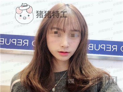 重庆铂生杜亚旭隆鼻案例价格分享,苦尽甘来的感觉一点都不夸张~