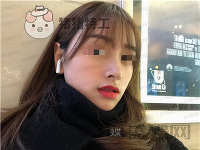 重庆铂生杜亚旭隆鼻案例价格分享,苦尽甘来的感觉一点都不夸张~
