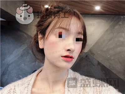 重庆铂生杜亚旭隆鼻案例价格分享,苦尽甘来的感觉一点都不夸张~