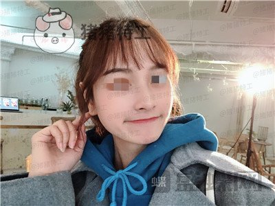 重庆铂生杜亚旭隆鼻案例价格分享,苦尽甘来的感觉一点都不夸张~