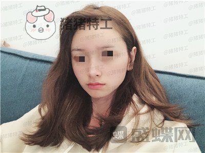 重庆铂生杜亚旭隆鼻案例价格分享,苦尽甘来的感觉一点都不夸张~