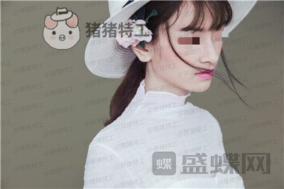 重庆铂生杜亚旭隆鼻案例价格分享,苦尽甘来的感觉一点都不夸张~