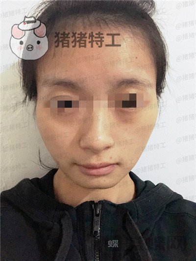 天津南开欧菲闫腾元面部填充案例价格分享,老阿姨蜕变小仙女.