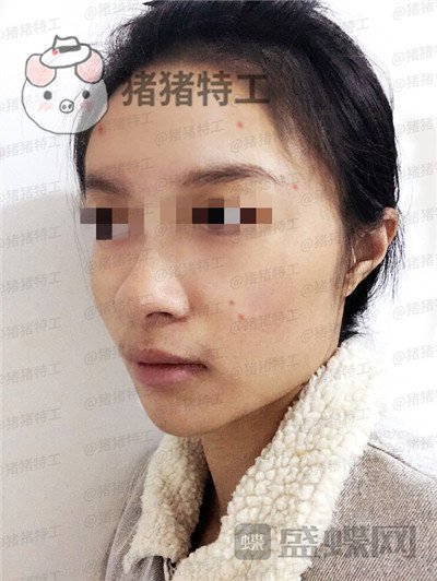 天津南开欧菲闫腾元面部填充案例价格分享,老阿姨蜕变小仙女.