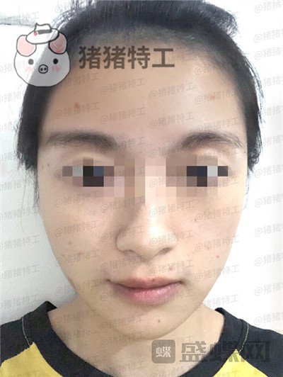 天津南开欧菲闫腾元面部填充案例价格分享,老阿姨蜕变小仙女.