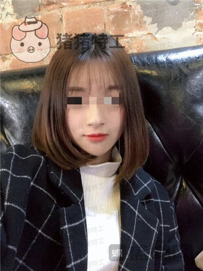 天津南开欧菲闫腾元面部填充案例价格分享,老阿姨蜕变小仙女.