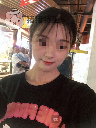 天津南开欧菲闫腾元面部填充案例价格分享,老阿姨蜕变小仙女.