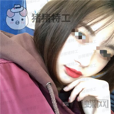 天津南开欧菲闫腾元面部填充案例价格分享,老阿姨蜕变小仙女.