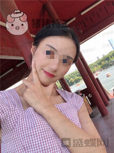 天津南开欧菲闫腾元面部填充案例价格分享,老阿姨蜕变小仙女.