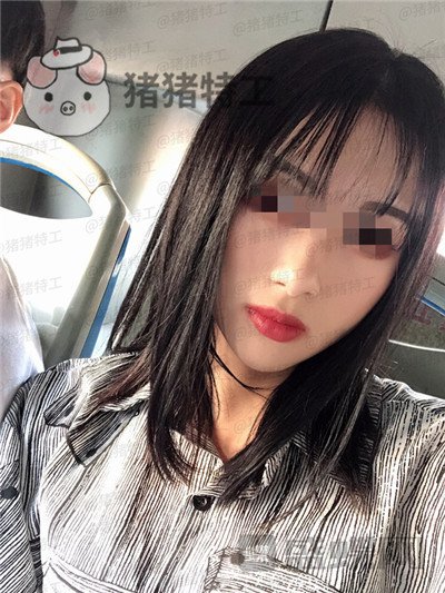 天津南开欧菲闫腾元面部填充案例价格分享,老阿姨蜕变小仙女.