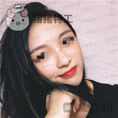 天津南开欧菲闫腾元面部填充案例价格分享,老阿姨蜕变小仙女.