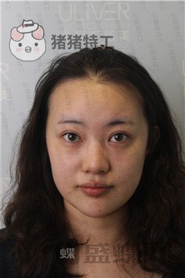 北京悦丽汇姚然鼻部手术案例价格分享,这个果不愧是院长亲自操作!