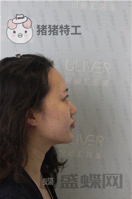 北京悦丽汇姚然鼻部手术案例价格分享,这个果不愧是院长亲自操作!