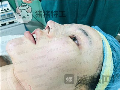 北京悦丽汇姚然鼻部手术案例价格分享,这个果不愧是院长亲自操作!