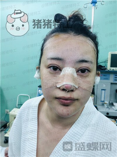 北京悦丽汇姚然鼻部手术案例价格分享,这个果不愧是院长亲自操作!