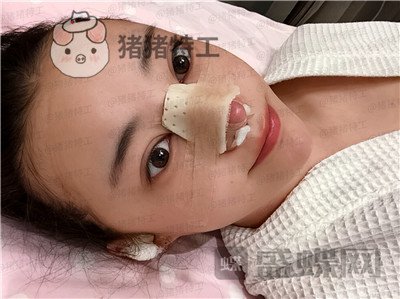 北京悦丽汇姚然鼻部手术案例价格分享,这个果不愧是院长亲自操作!