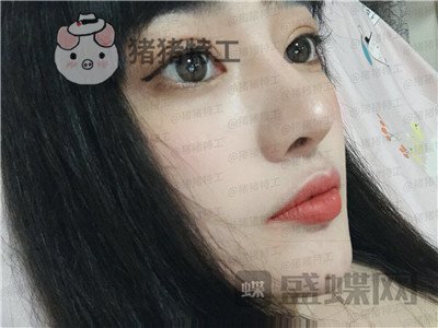 北京悦丽汇姚然鼻部手术案例价格分享,这个果不愧是院长亲自操作!