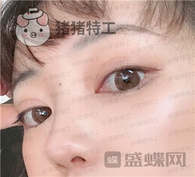 北京悦丽汇姚然鼻部手术案例价格分享,这个果不愧是院长亲自操作!