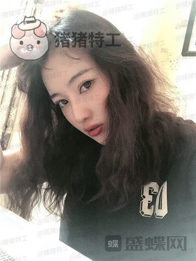北京悦丽汇姚然鼻部手术案例价格分享,这个果不愧是院长亲自操作!