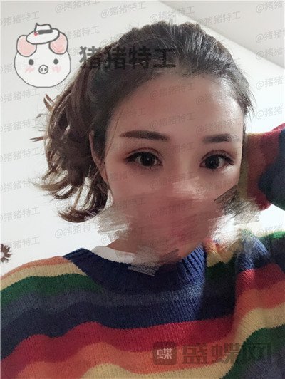 成都西区医院车红昌双眼皮案例价格分享，这种可爱类型的双眼皮你们喜欢吗？