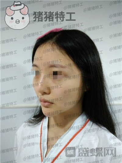 上海九院李茂群隆鼻案例价格分享,垫了鼻子法令纹竟然神奇的消失了!