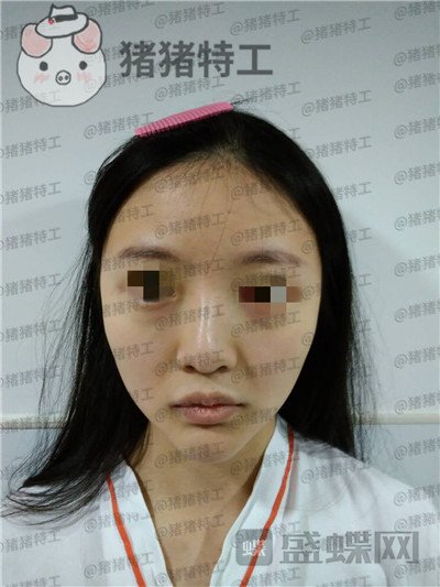 上海九院李茂群隆鼻案例价格分享,垫了鼻子法令纹竟然神奇的消失了!
