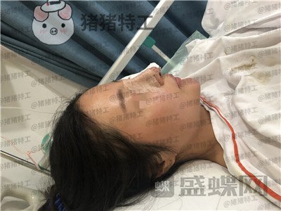 上海九院李茂群隆鼻案例价格分享,垫了鼻子法令纹竟然神奇的消失了!