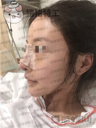 上海九院李茂群隆鼻案例价格分享,垫了鼻子法令纹竟然神奇的消失了!
