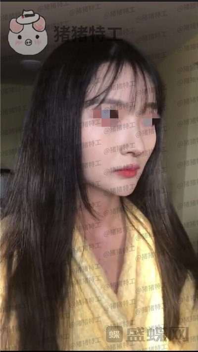 上海九院李茂群隆鼻案例价格分享,垫了鼻子法令纹竟然神奇的消失了!