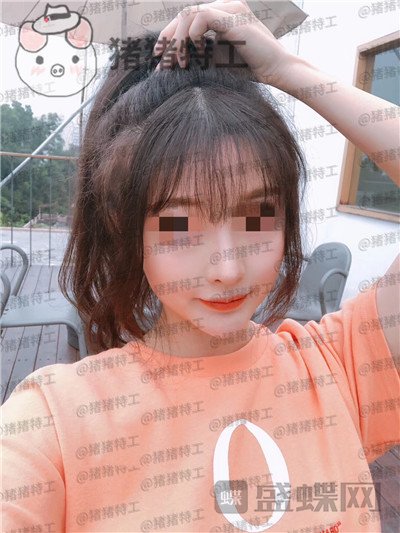 上海九院李茂群隆鼻案例价格分享,垫了鼻子法令纹竟然神奇的消失了!