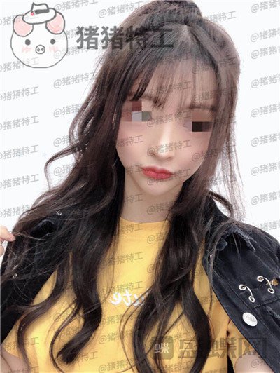 上海九院李茂群隆鼻案例价格分享,垫了鼻子法令纹竟然神奇的消失了!