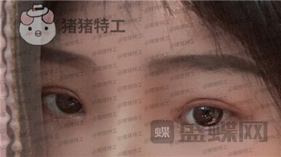 西安高一生刘军双眼皮案例价格分享,朋友说我割了还不如不割?
