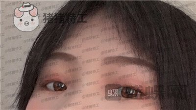 西安高一生刘军双眼皮案例价格分享,朋友说我割了还不如不割?