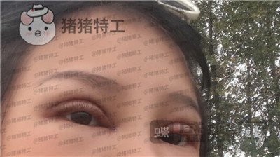 西安高一生刘军双眼皮案例价格分享,朋友说我割了还不如不割?