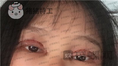 西安高一生刘军双眼皮案例价格分享,朋友说我割了还不如不割?