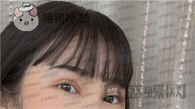 西安高一生刘军双眼皮案例价格分享,朋友说我割了还不如不割?