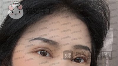 西安高一生刘军双眼皮案例价格分享,朋友说我割了还不如不割?
