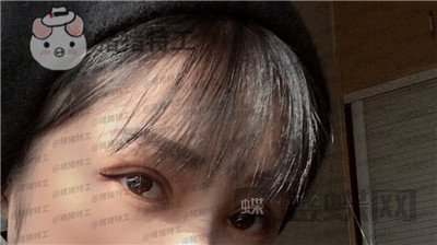 西安高一生刘军双眼皮案例价格分享,朋友说我割了还不如不割?
