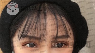 西安高一生刘军双眼皮案例价格分享,朋友说我割了还不如不割?