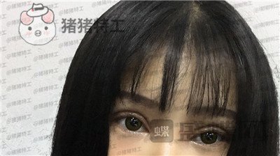 西安高一生刘军双眼皮案例价格分享,朋友说我割了还不如不割?