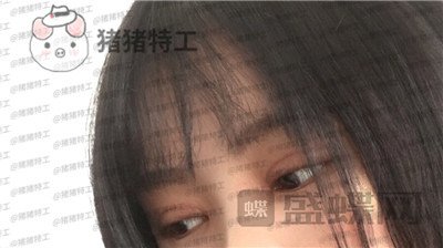 西安高一生刘军双眼皮案例价格分享,朋友说我割了还不如不割?