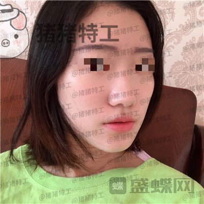 武汉华美马行鼻部手术案例价格分享,优惠的价格竟然可以做的这么完美!