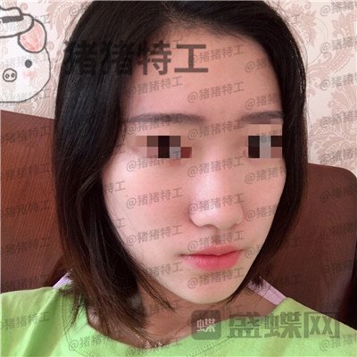 武汉华美马行鼻部手术案例价格分享,优惠的价格竟然可以做的这么完美!
