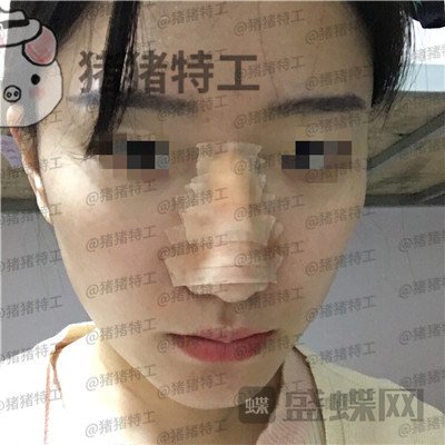 武汉华美马行鼻部手术案例价格分享,优惠的价格竟然可以做的这么完美!