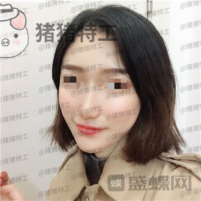 武汉华美马行鼻部手术案例价格分享,优惠的价格竟然可以做的这么完美!